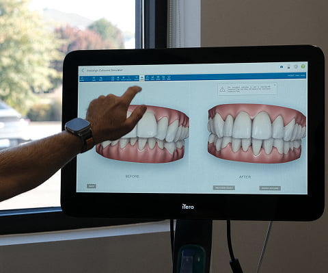 The process of creating aligners